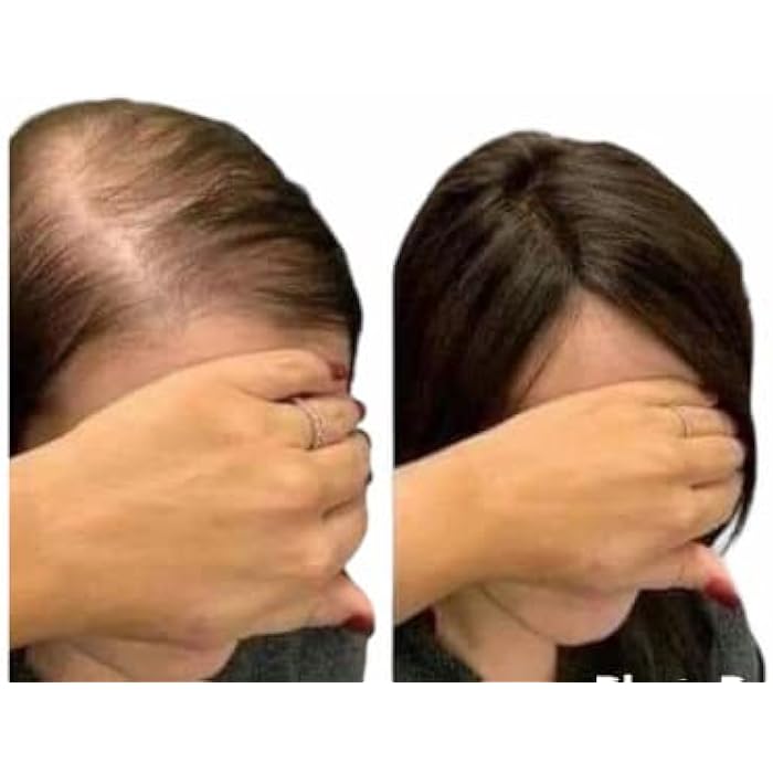 Olex Oil Garlic Hair Loss 5 Ampoule - Image 2